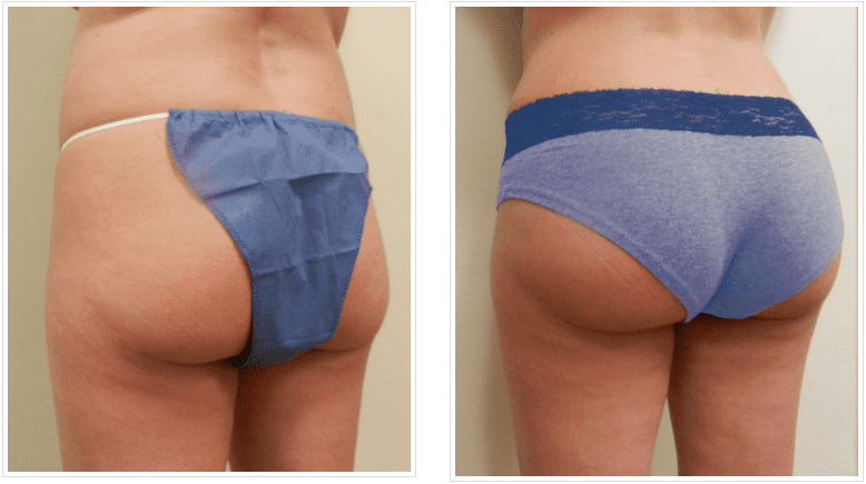 before and after Buttock Enhancement Chicago IL