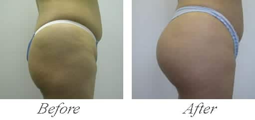 Buttock Aug Before and after