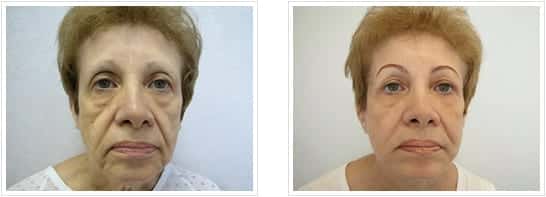 female before and after Facelift (Rhytidectomy)