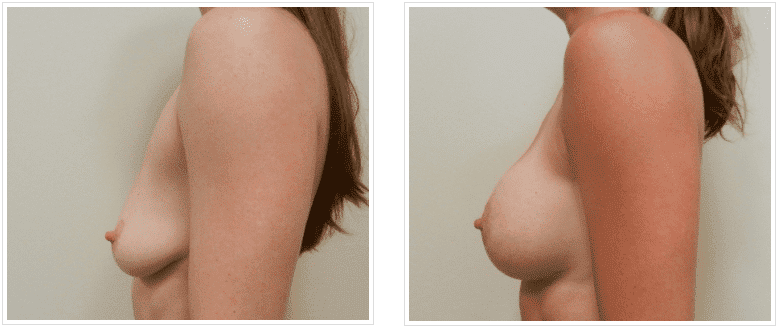 before and after Breast Lift Chicago IL