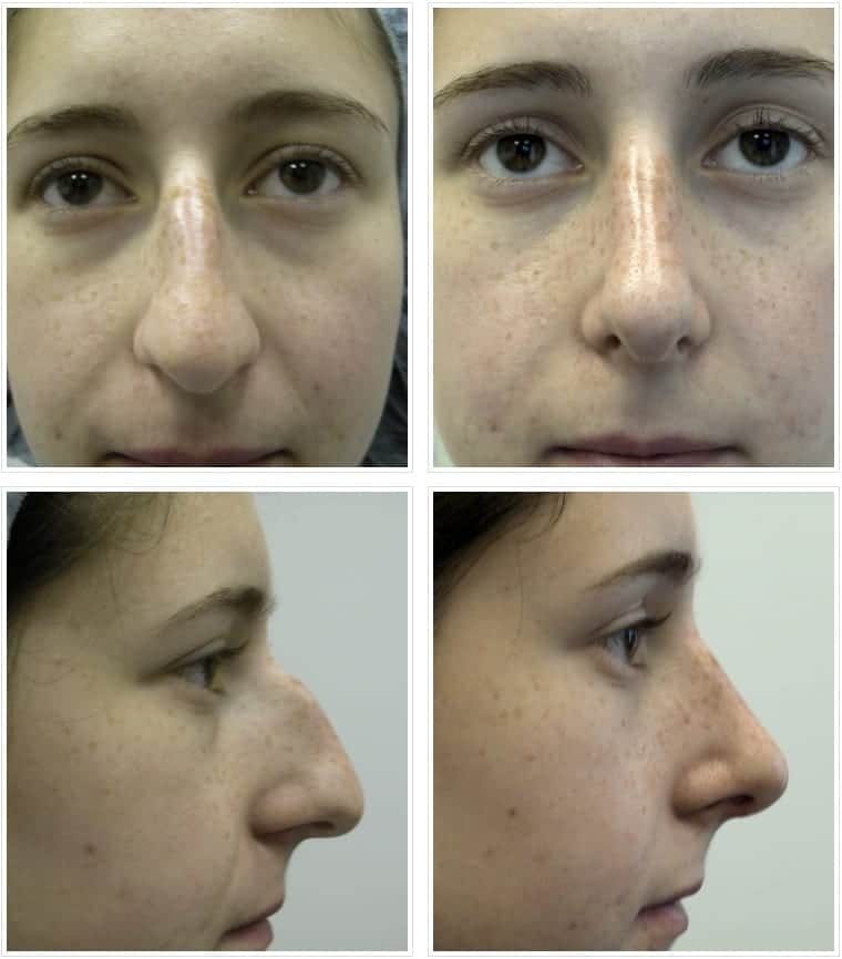 before and after Rhinoplasty Chicago IL