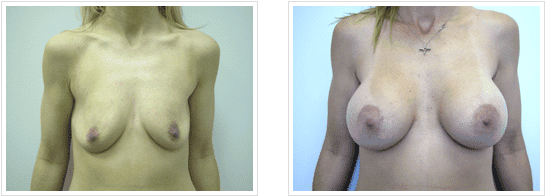 before and after Breast Augmentation with Lift Chicago IL