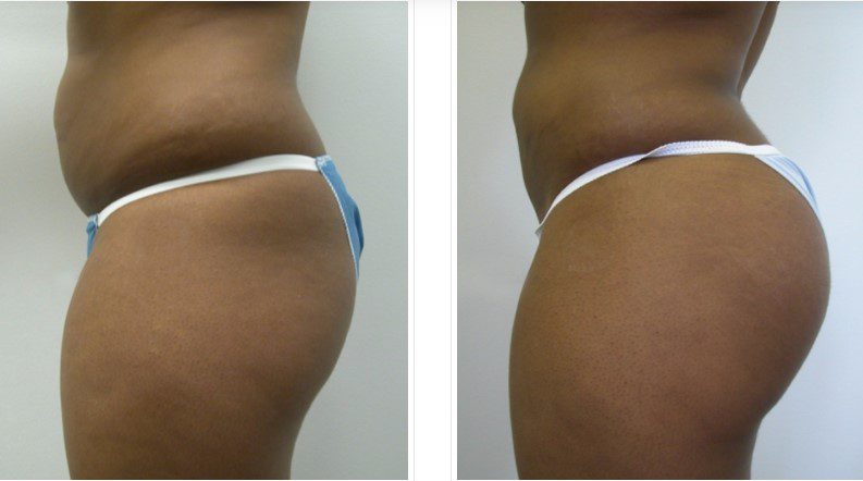 side view of female patient’s buttocks before and after augmentation, buttocks larger and more pronounced after procedure