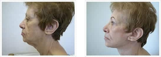 side profile of elderly female patient before and after neck and facelift procedure