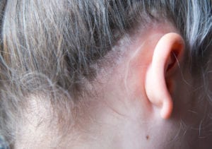 Ear Lift Surgery Chicago IL