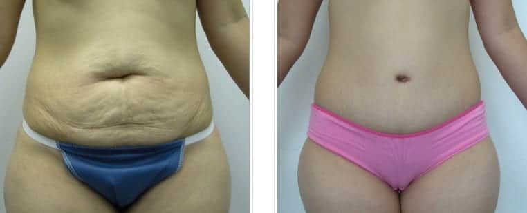 before and after tummy tuck chicago IL