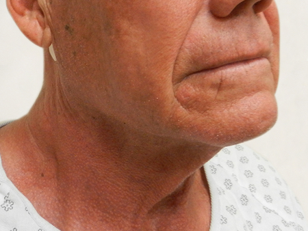 Before Image: Patient # 14086 - 