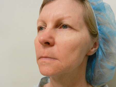 Before Image: Patient # 89860 - 