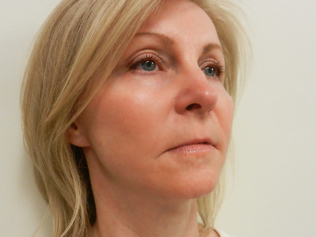 After Image: Patient # 89860 - 