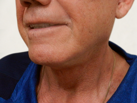 After Image: Patient # 14086 - 