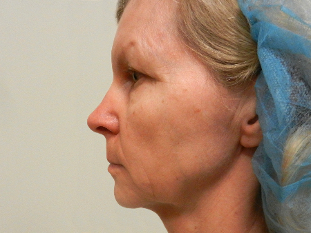 Before Image: Patient # 89860 - 