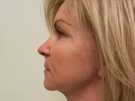 After Image: Patient # 89860 - 