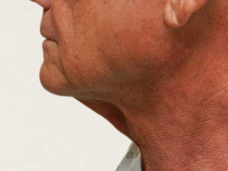 Before Image: Patient # 14086 - 