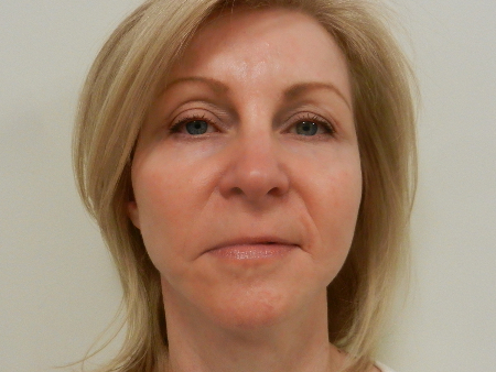 After Image: Patient # 89860 - 