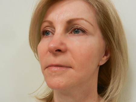 After Image: Patient # 89860 - 
