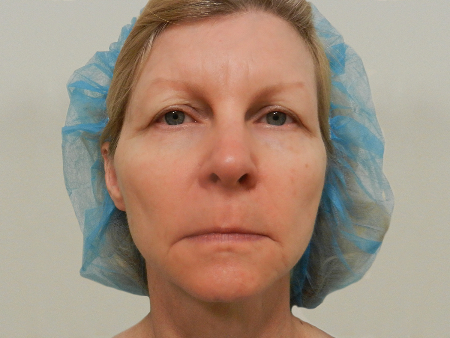 Before Image: Patient # 89860 - 