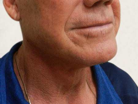After Image: Patient # 14086 - 