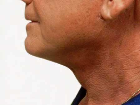 After Image: Patient # 14086 - 