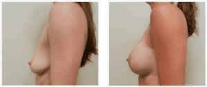 Mastopexy Breast Lift Chicago IL 300x126 1