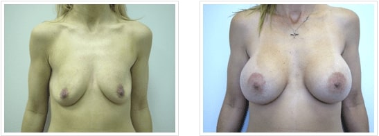 breast augmentation with Breast Lift Chicago IL
