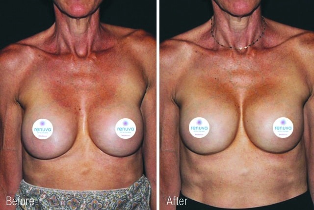 Before After Renuva Breast Treatment Chicago IL