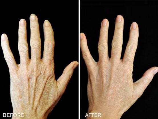 Before After Renuva Treatment Chicago IL