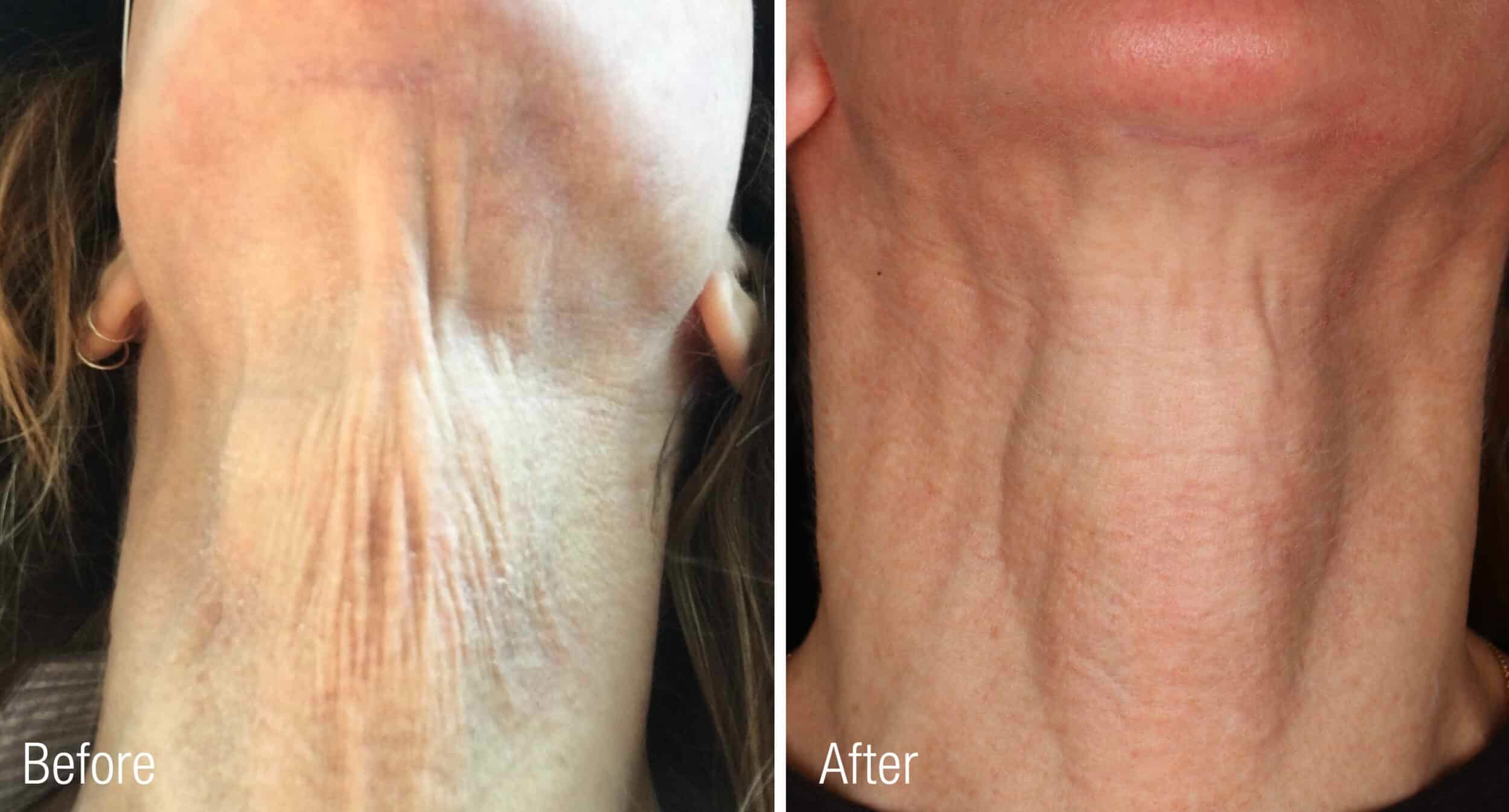 Before After Renuva Injectable Treatment Chicago IL