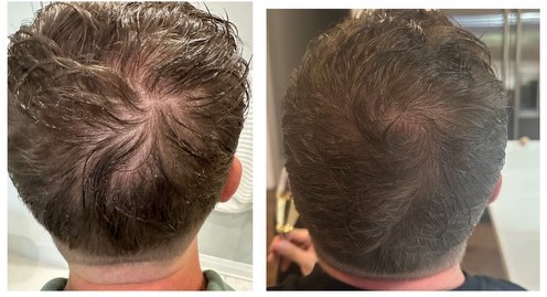 before after Hair Restoration Treatment Chicago IL