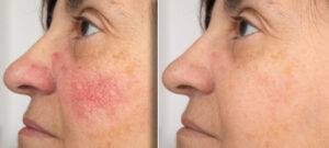 Before and after photo shows woman with even skin tone after addressing unwanted redness