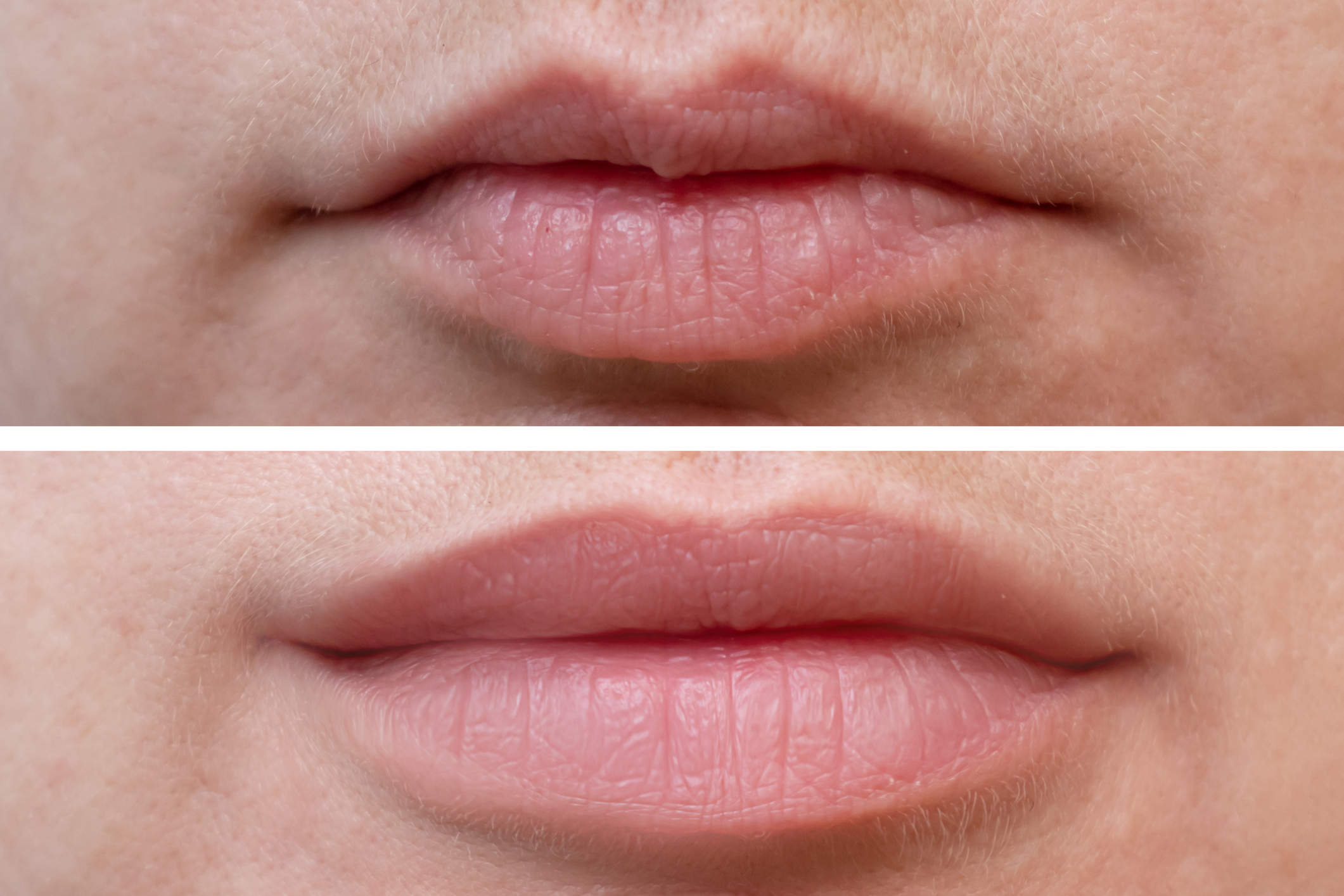 Female lips before and after augmentation, the result of using hyaluronic filler