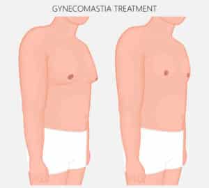 Woman has a new figure after significant weight loss. Diagram shows side-by-side comparison of man with gynecomastia and man with flat chest contour.
